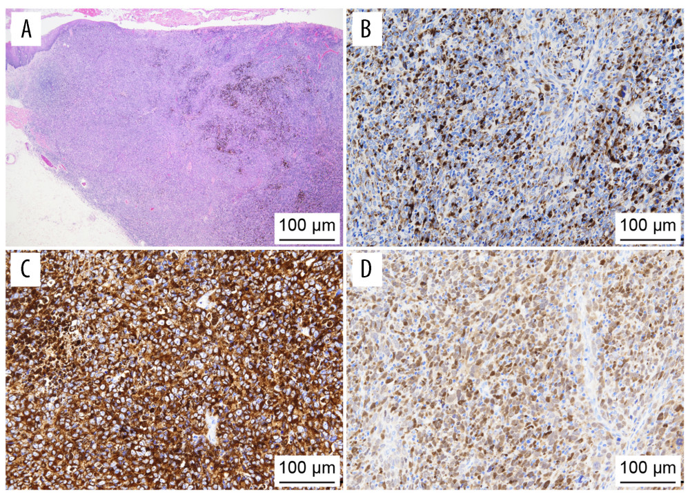(A) Tumor cells with nucleoli and swelling anisocytosis of different sizes densely proliferating in sheet-like and large-sized follicle-like forms. The lesion was accompanied by the deposition of melanin pigment. Cellular proliferation of melanocytes was observed on the intraepithelial basal side of the melanoma around the tumor, but no development of malignant melanoma was observed (hematoxylin and eosin, ×20). (B) Immunohistochemical staining for MelanA was positive (×200). (C) Immunohistochemical staining for HMB45 was positive (×200). (D) Immunohistochemical staining for S100 was positive (×200).