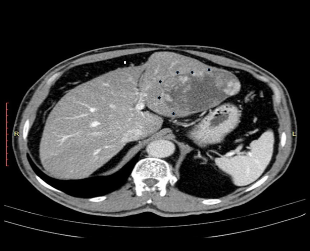Plain computed tomography revealed a solitary liver lesion in the left lobe with well-defined margins and heterogeneous enhancement (black arrowheads).