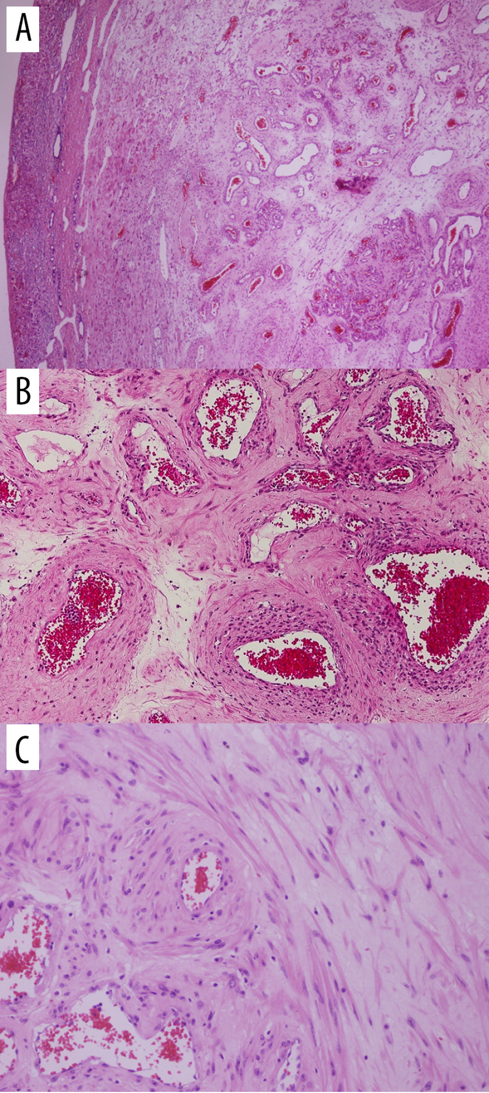 At low magnification, a well-circumscribed tumor in the liver is seen (A, hematoxylin and eosin, 40×). At high magnification, presenting with thick muscle-coated blood vessels (B, hematoxylin and eosin, 200×) with inter- and perivascular smooth muscle bundles (C, hematoxylin and eosin, 200×).