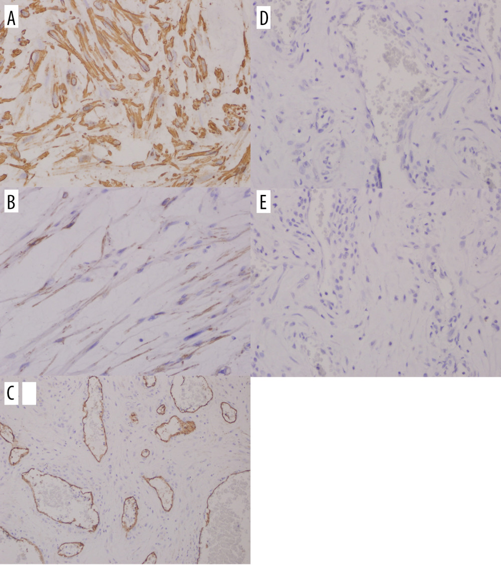 Immunohistochemically, the tumors are positive for small muscle actin (A, 400×) and weakly positive for desmin (B, 400×). Perivascular spindle cells of the tumor were negative for CD34 (C, 200×), HMB-45 and S-100 (D, E, 400×).