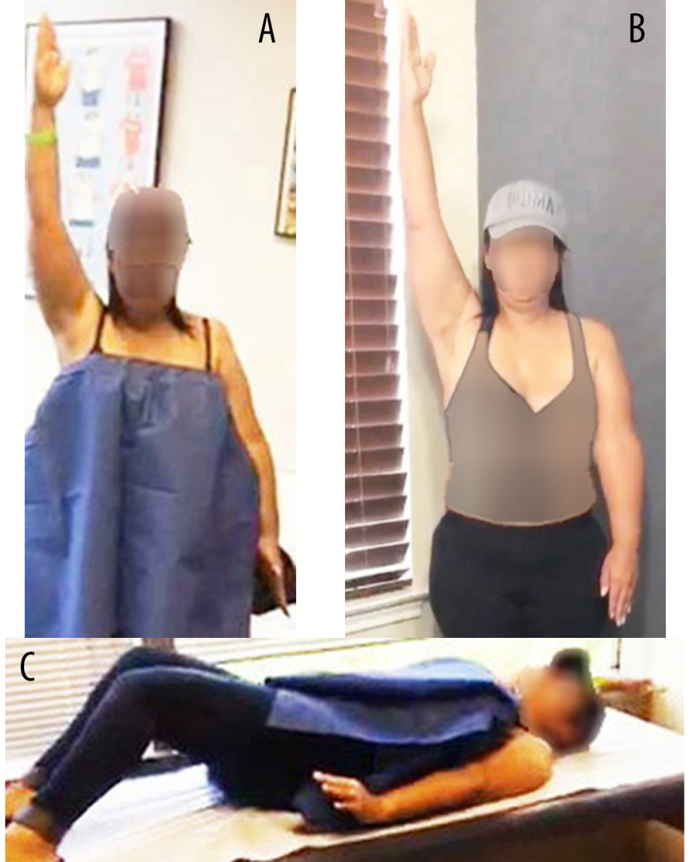 (A–C) Before surgery with us, but after ACDF surgery. The 45-year-old woman in our report presented with complete paralysis of the LUE and 0 degrees in shoulder abduction.
