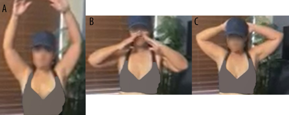 (A–C) Show the patient’s left upper limb active range of motion (AROM) 17 months after the nerve transfer procedure with the senior author (RKN).
