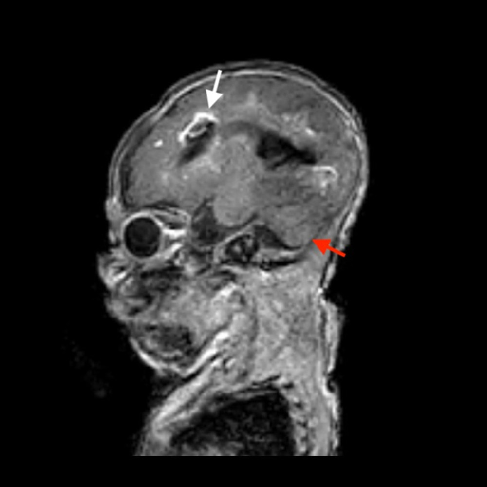 Postnatal magnetic resonance imaging of brain without contrast: sagittal view demonstrating intracranial abnormalities within the periventricular parenchyma, including diffusion restriction hemorrhage and possible calcification (white arrow), in the setting of multifocal infarcts of unknown etiology. Dysgenesis of the corpus callosum and inferior vermian hypoplasia are also apparent (red arrow).