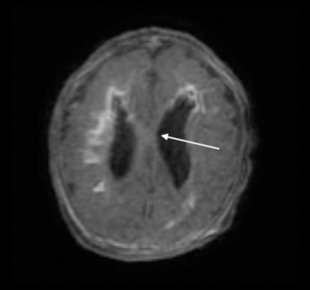 Postnatal magnetic resonance imaging of brain without contrast: axial view demonstrating diffuse mild polymicrogyria, dysgenesis of the corpus callosum, and defect within the intraventricular septum (arrow).