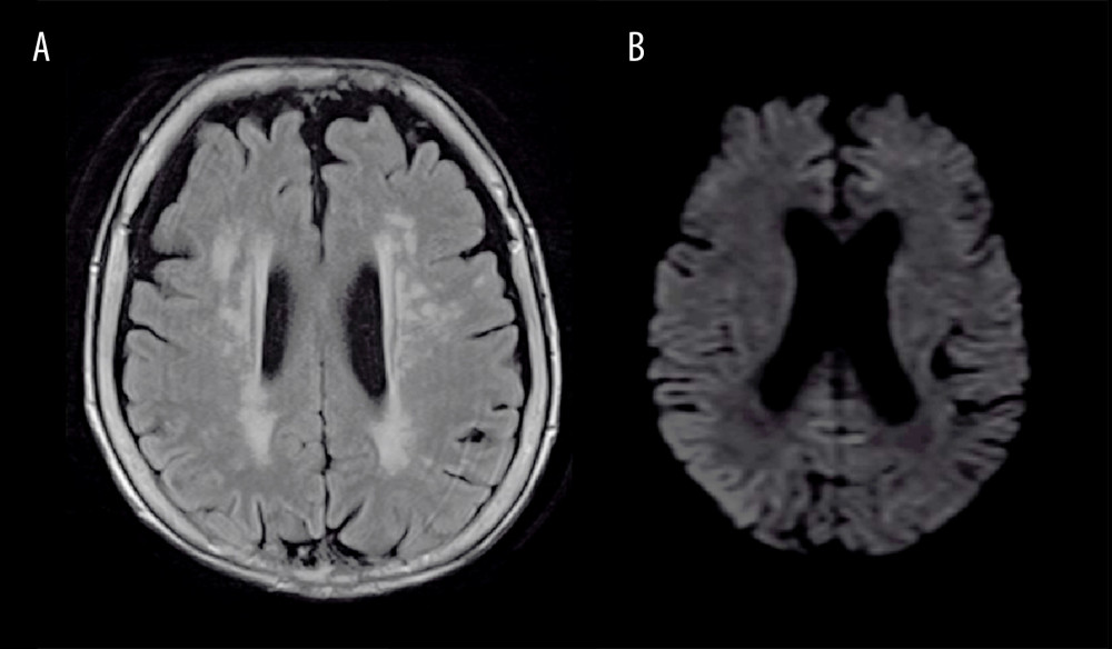 Cranial magnetic resonance imaging findings. (A) Fluid-attenuated inversion recovery (FLAIR) image. (B) Diffusion-weighted image. FLAIR and diffusion-weighted images failed to show an area of hyperintensity in the cerebral cortex, basal ganglia, or thalamus.