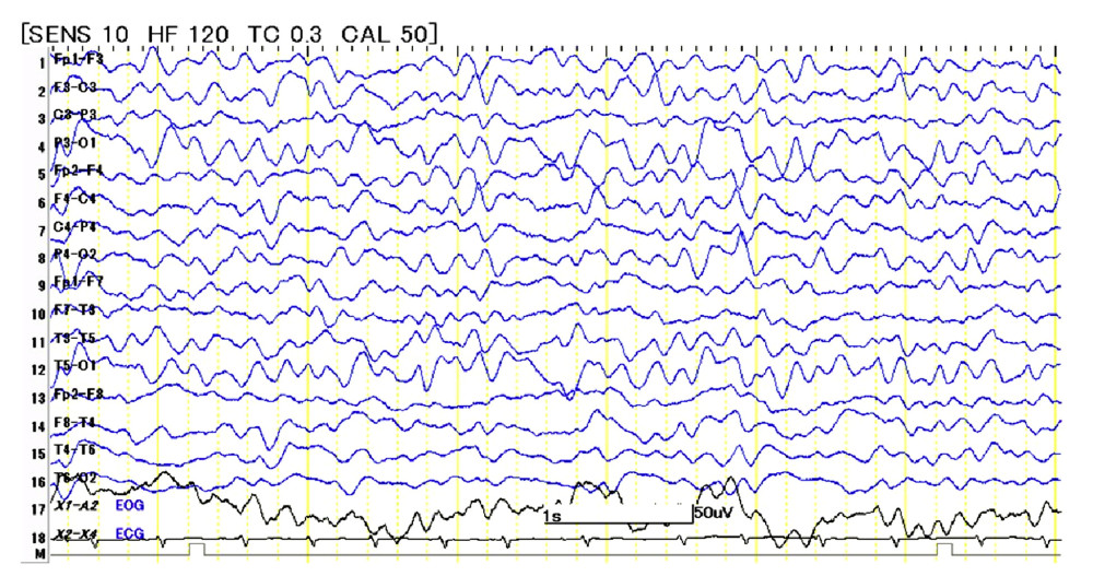 Electroencephalography findings. Electroencephalography showed generalized slow waves, mainly delta waves, without periodic synchronous discharges.