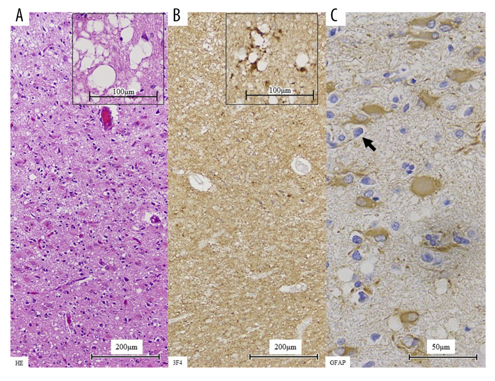 Microscopic findings of brain tissue. (A) Hematoxylin and eosin staining of the medial basal aspect of the right occipital lobe showed neuronal loss, spongiform change of the cortex, and neuropil rarefaction. (B) Immunostaining for prion protein with 3F4 antibody to the same area showed deposits of the synaptic type of prion protein. (C) Immunohistochemical staining for glial fibrillary acidic protein showed hypertrophic astrocytes.
