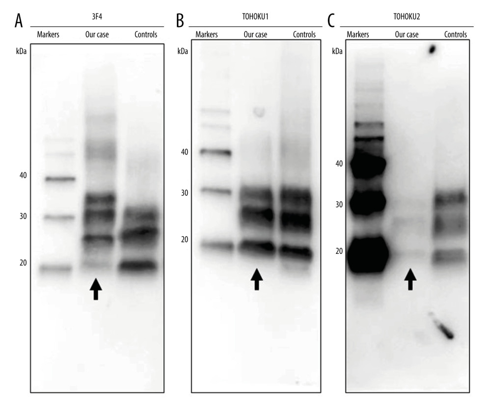 Western blot with frozen specimen of right occipital lobe. (A) Western blot using 3F4 antibody showed the presence of protease-resistant PrP. (B) Western blot using polyclonal antibody specific for (b) type 1 PrPSc and (C) type 2 PrPSc (Tohoku1 and Tohoku2, respectively) showed bands compatible with each antibody.