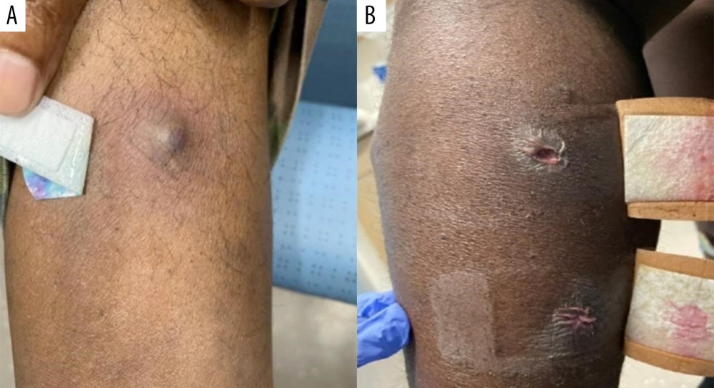 (A) Photograph of one of multiple skin lesions from a 44-year-old man with a diagnosis of blastomycosis. This lesion is located on the upper arm of the patient. (B) Photograph of 2 draining skin lesions from a 44-year-old man with a diagnosis of blastomycosis. These lesions are located on the lower leg of the patient.