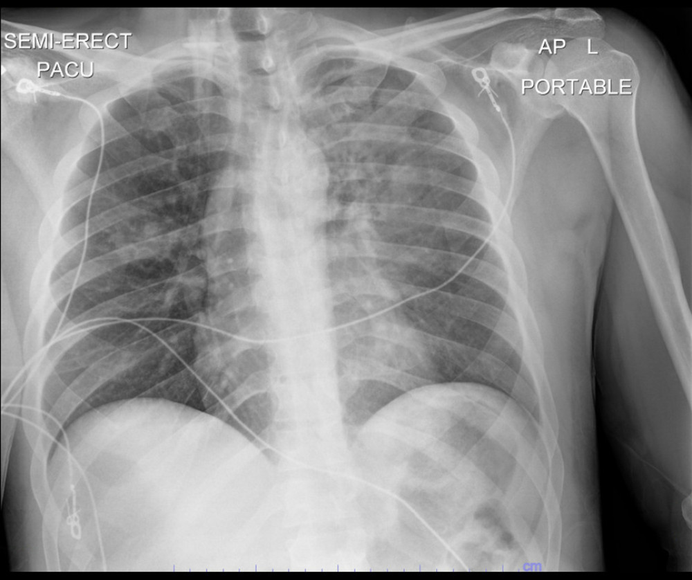Chest X-ray in anterior-posterior view of a 44-year-old man with a diagnosis of blastomycosis prior to treatment. This chest X-ray demonstrates bilateral upper-lobe consolidative opacities with foci of cavitation.