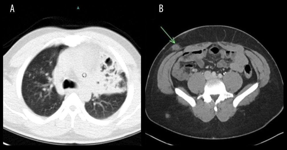 (A) Computed tomography (CT) scan of the chest of a 44-year-old man with a diagnosis of blastomycosis prior to treatment. This CT scan shows consolidative opacity involving almost the entire left upper lobe with multiple areas of irregular cavitation. (B) Computed tomography (CT) scan of the abdomen and pelvis of a 44-year-old man with a diagnosis of blastomycosis prior to treatment. This CT scan shows one of the multiple low-density soft-tissue nodules in the deeper fatty plane, as indicated by the green arrow.