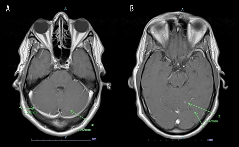 (A) Magnetic resonance imaging (MRI) of the brain of a 44-year-old man with a diagnosis of blastomycosis prior to treatment. This MRI slice shows 2-mm and 3-mm enhancing foci in the left and right cerebellar hemispheres, as indicated by the green arrows. (B) Magnetic resonance imaging (MRI) of the brain of a 44-year-old man with a diagnosis of blastomycosis prior to treatment. This MRI slice shows a 3-mm enhancing focus in the left superior cerebellar hemisphere, as indicated by the green arrow.