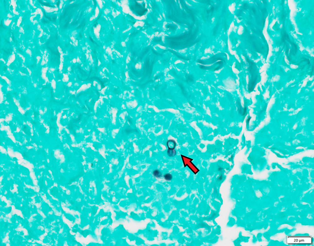 Photomicrograph of the skin sample from a 44-year-old man with a diagnosis of blastomycosis. The tissue section of the skin is stained with methenamine silver to show the round, budding yeast forms of Blastomycosis dermatitidis, as indicated by the red arrow. Magnification ×60.