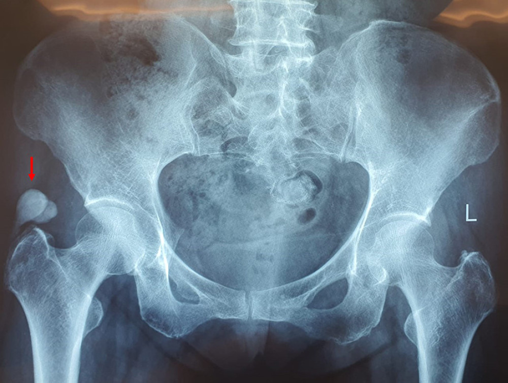 Pelvic anteroposterior (AP) radiograph showing calcification over the right greater trochanter (red arrow).