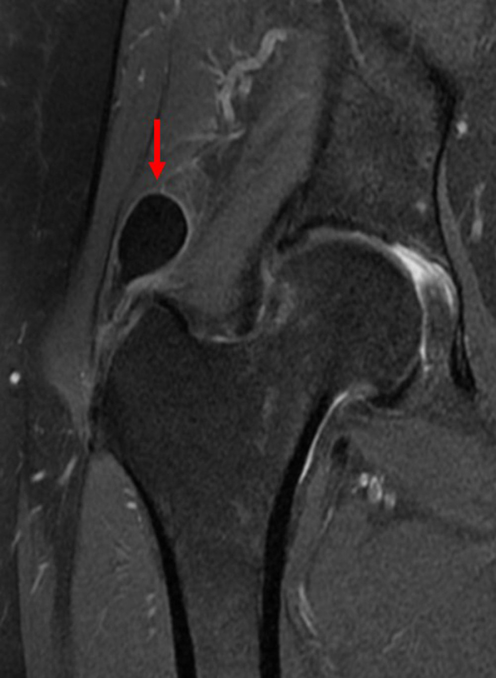 Proton density-weighted coronal image of right hip calcification (red arrow).