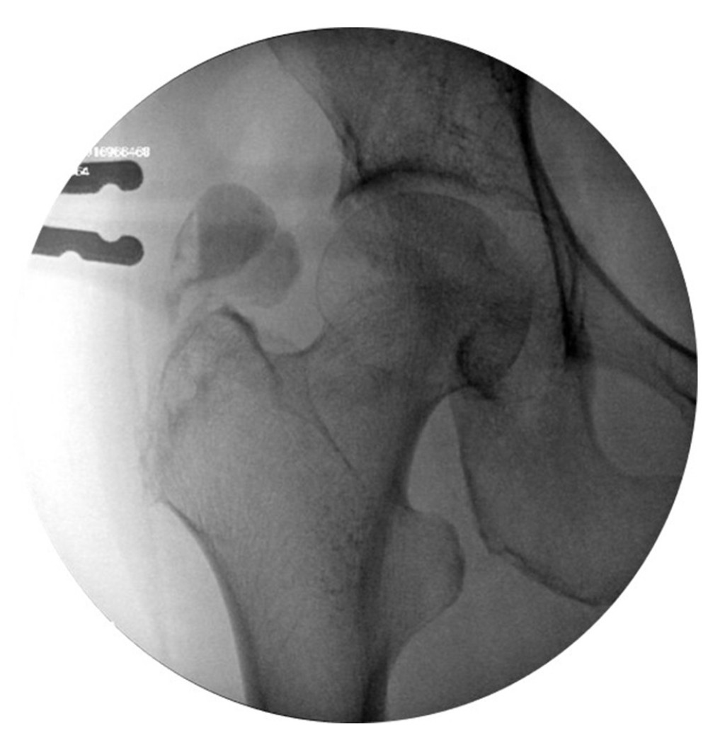 Intraoperative imaging showing air-fluid level within the lesion (patient in left lateral position).