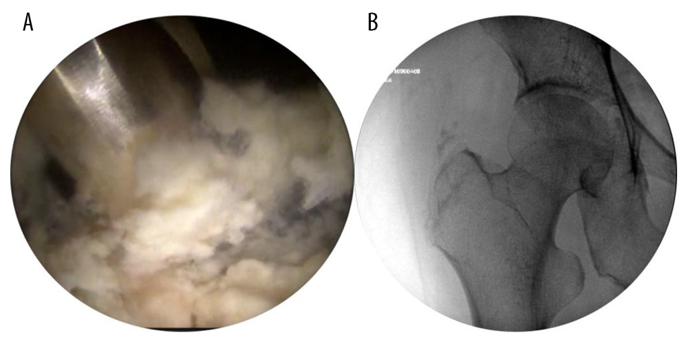 Endoscopic image showing debridement of the calcification (A), and intraoperative imaging after debridement showing clearance of the lesion (B).