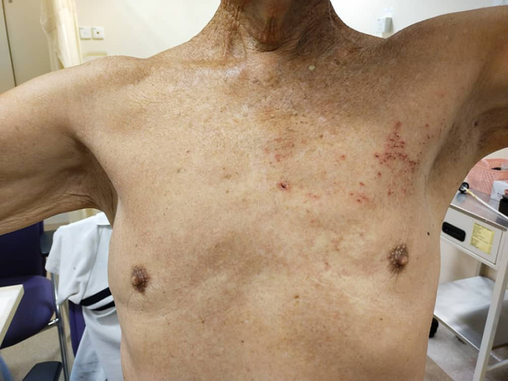 Healed lesions on the left chest wall along the T3 dermatome during follow-up.
