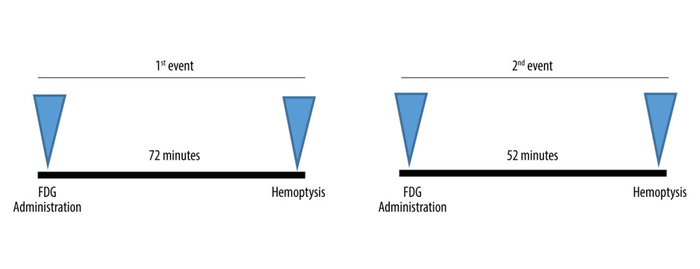 A timeline of events comparing duration gaps between [18F] FDG intravenous administration and hemoptysis in both events of hemoptysis.