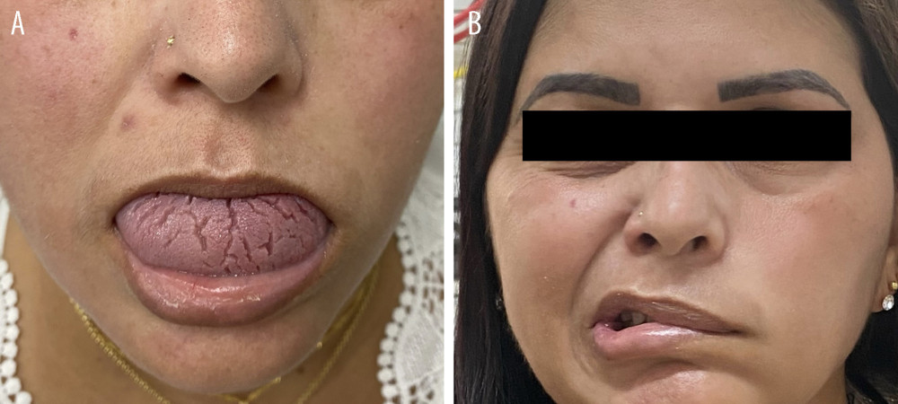 Melkersson-Rosenthal syndrome presenting with (A) facial edema and tongue fissuring and (B) peripheral facial paralysis.