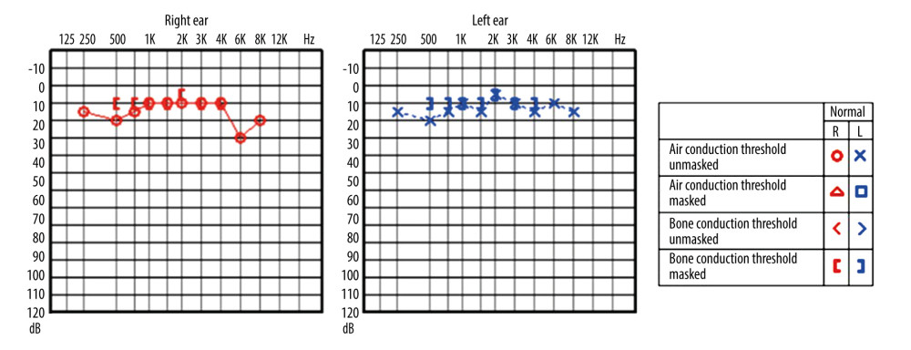 Pure tone audiometry.