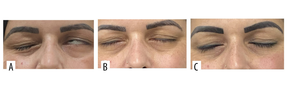 Images of the upper face: (A) initial status exhibiting a House-Brackmann grade VI palsy; (B) improvement of motor facial function after 1 month of treatment with a grade III palsy; and (C) improvement of motor facial function after 8 months of treatment with a grade II palsy.