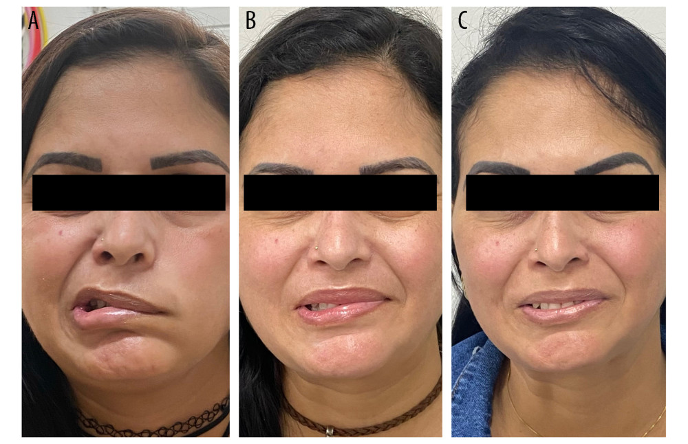 Facial motor function improvements: (A) initial status exhibiting a House-Brackmann grade VI palsy; (B) after 1 month of treatment, grade III palsy; and (C) after 8 months of treatment, grade II palsy.