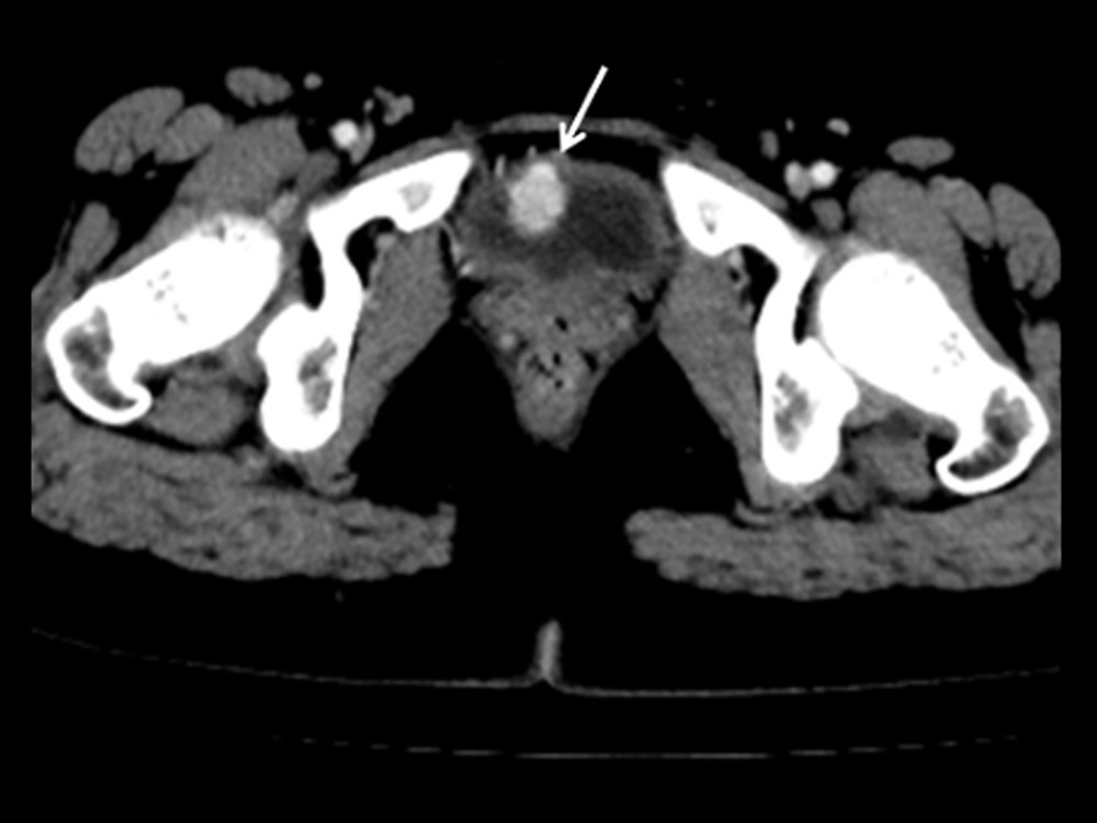 Axial CT image of the pelvis from a portovenous phase of a contrast-enhanced exam shows a well-defined, irregular hyper-enhancing polypoid lesion arising from the urinary bladder wall (arrow). This lesion is hypoattenuating on non-contrast CT. CT – computed tomography.
