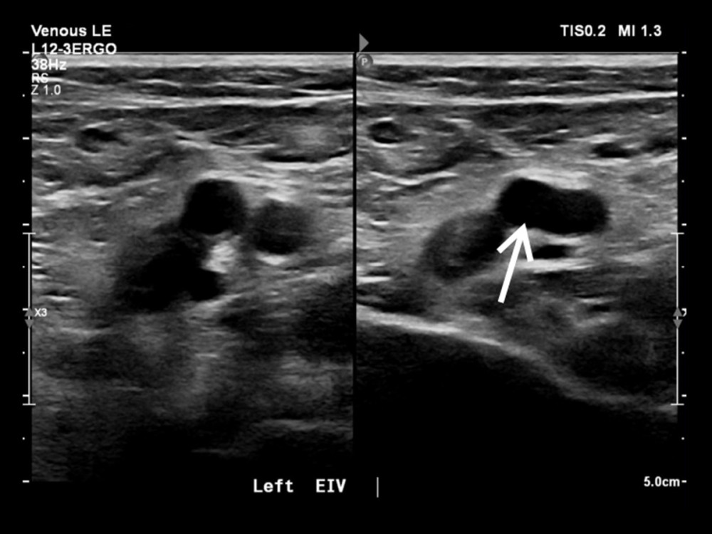 Official ultrasound of the patient showing signs of DVT (noncompressibility) in the left external iliac veins. The arrow is pointing to the site of non-compressibility in the left external iliac vein. DVT, deep vein thrombosis.