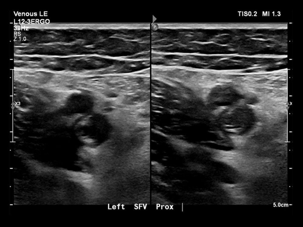 Official ultrasound of the patient showing signs of DVT (noncompressibility) in the left superficial femoral veins. DVT, deep vein thrombosis.