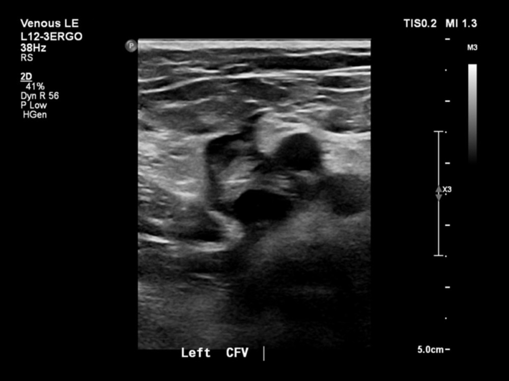 Official ultrasound of the patient showing signs of DVT (noncompressibility) in the left common femoral veins. Power of magnification: 38 Hz; plane of view: transverse; method of staining: 2-dimensional gray scale; DVT, deep vein thrombosis.