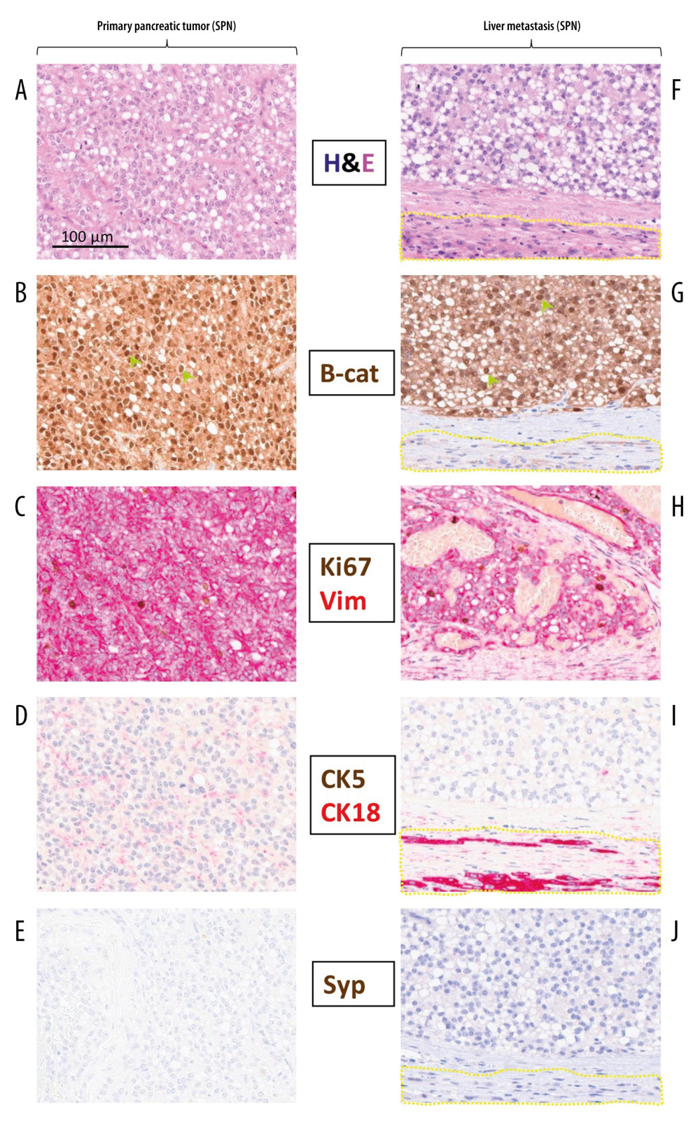 (A, F) Histology of primary and liver metastasis of solid pseudopapillary neoplasm of the pancreas on hematoxylin and eosin (H&E) staining. The photomicrographs show monomorphic epithelial cells with vacuolated cytoplasm in solid sheets. (B–E, G–J) Immunohistochemical staining demonstrates the characteristic profile of solid pseudopapillary neoplasm of the pancreas: beta-catenin (B-cat: nuclear and cytoplasmic positivity), vimentin (Vim: positive), cytokeratins (CK18, CK5: negative), synaptophysin (Syp: negative). Text colors correspond to the staining chromogens. Yellow dotted area (F, G, I, J) indicates atrophic peritumoral hepatocytes. Green arrows (B, G) indicate beta-catenin+tumor cell nuclei.