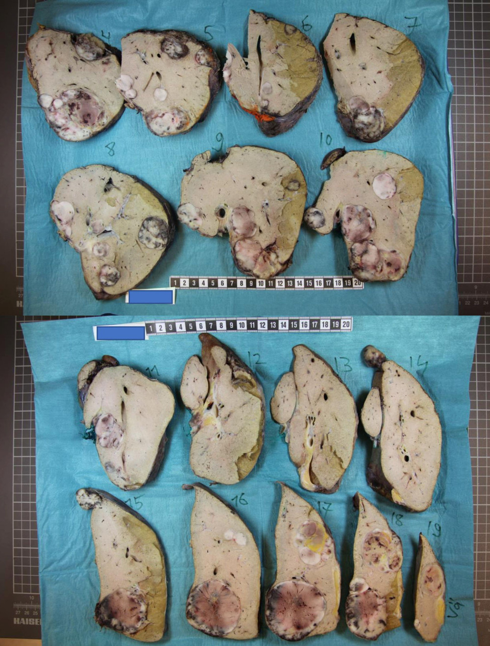 Sagittal cross-section of the explanted liver with multiple metastases. A centimeter ruler is shown in figures for scale.