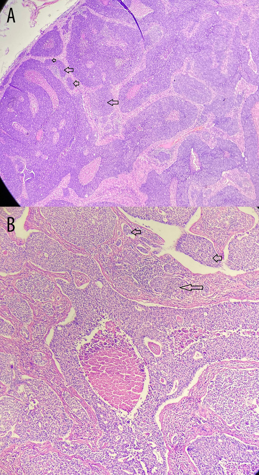 Microscopic appearance of pelvic lymph nodes. Pelvic lymph nodes were partially covered by connective tissue capsule. The subcapsular consisted of lymphoid stroma. Invading malignant tumor cells were seen (arrows). (A) Right pelvic lymph node. (B) Left pelvic lymph node.