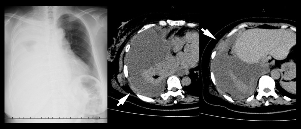 Chest X-ray and CT on the 1st hospital day. Chest X-ray showing right massive pleural effusion. CT showing right massive pleural effusion and collapse of the right lung. Partial pleural thickening can be noted retrospectively (white arrow).