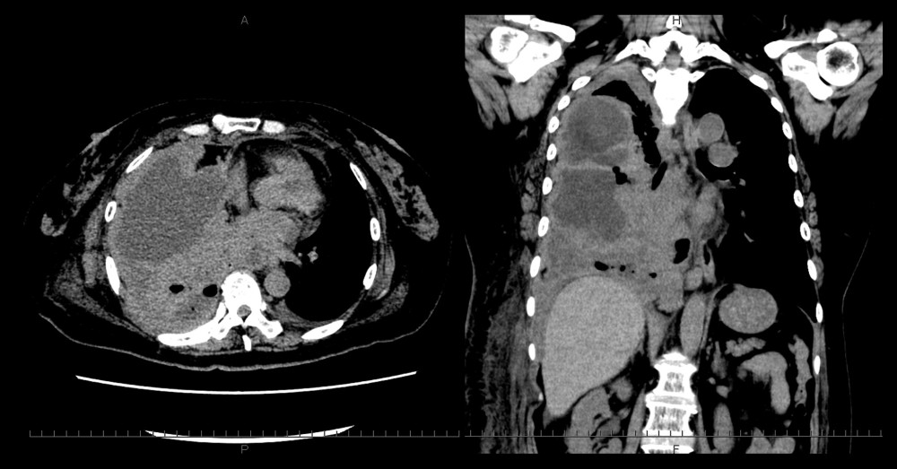 CT on 8th hospital day. CT showing many encapsulated fluid cavities in right thoracic cavity. It showed inflammation in the thoracic cavity, suggesting empyema.