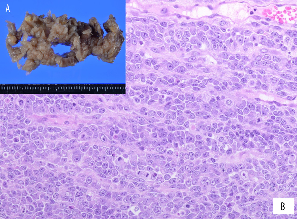 Resected tumor and pathological findings. (A) A portion of the resected tumor was submitted for pathological diagnosis. The specimen was thickened, elastic, and hard, like a tumorous lesion rather than inflammatory fibrin tissue. (B) Tumor cells showing an undifferentiated morphology with an oval nucleus with increased chromatin and a narrow cytoplasm are observed.