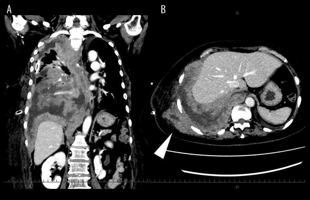 Axial and coronal enhanced CT on 19th hospital day (POD 5). (A) Although the thoracic cavity was curetted, new pleural thickening was observed. A thick tumorous growth was seen, especially on the diaphragm, which was hardly curetted in surgery. The left thoracic cavity was compressed due to rapid growth of the tumor. (B) Growth of disseminated tumor tissue was observed in the subcutaneous tissue at the site of initial chest drainage (white arrowhead).