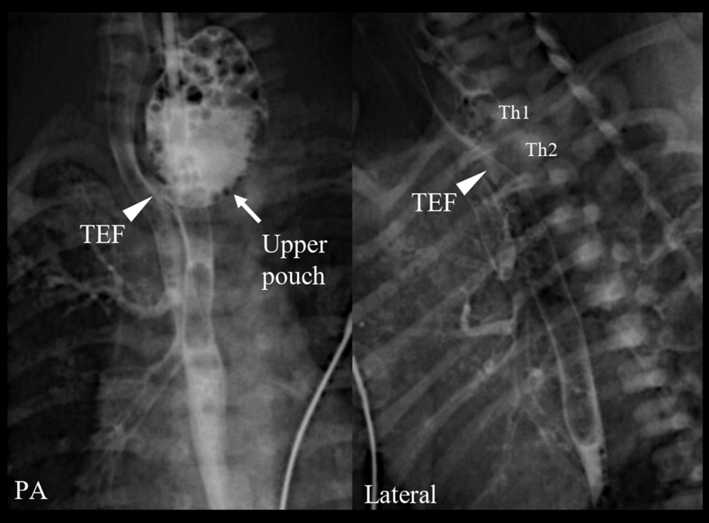 A contrast examination shows that the tracheoesophageal fistula (arrowhead) and the upper end of the esophageal pouch (arrow) are at the second thoracic vertebrae (Th2). The contrast was injected through a nasogastric tube.