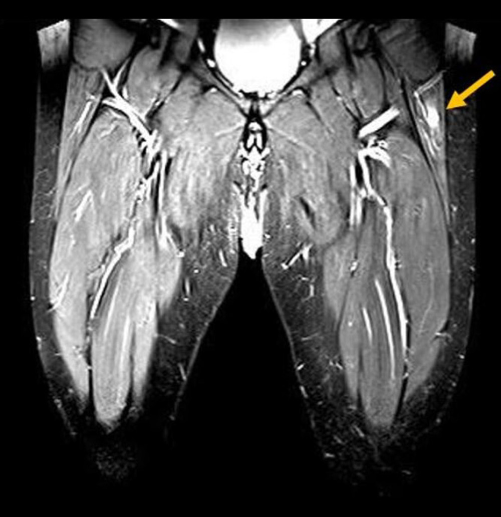 T2-weighted magnetic resonance imaging (MRI) with contrast for both thighs showed a high signal intensity (arrow) in the left upper thigh (coronal view).