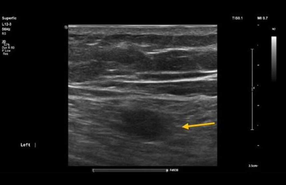 Ultrasound imaging revealed a round, solid, hypoechoic, homogeneous mass (arrow) in the left upper thigh.