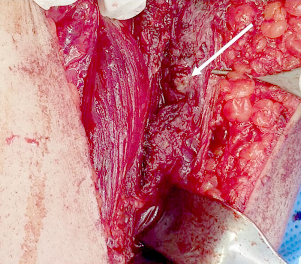 Intraoperative picture. An anterolateral approach was performed for tumor excision. The tumor was found within the tensor fascia lata and was yellowish-gray in color.
