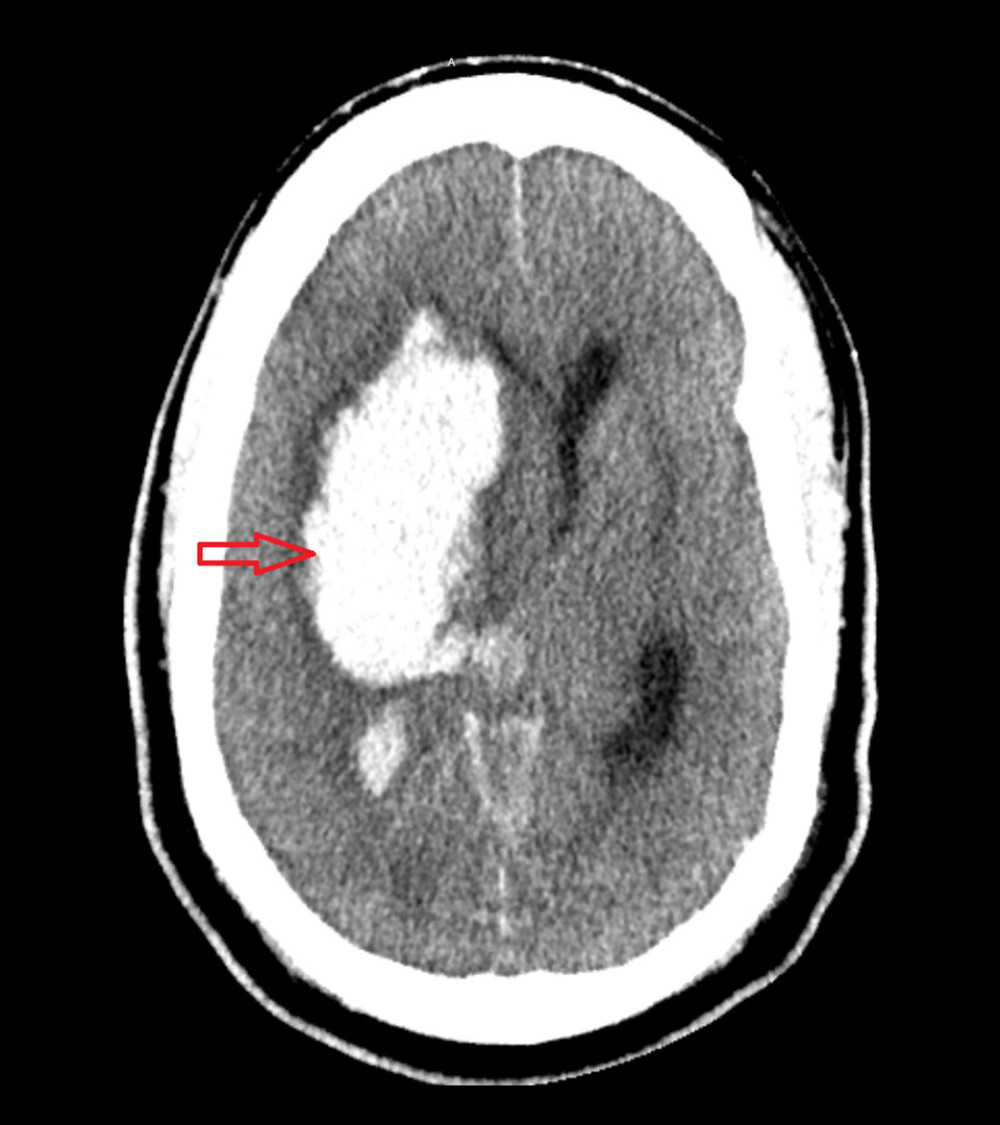 Non-contrast CT head of 42-year-old man about 45 hours after presenting to the emergency room with methanol ingestion showing right basal ganglia intraparenchymal hemorrhage with midline shift, indicated by the red arrow.