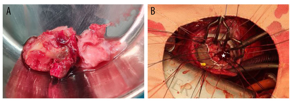 (A) Intraoperative documentation: thrombus found in the left atrial. (B) Intraoperative documentation before bioprosthetic implantation. White star: MV condition after calcified leaflets and commissure fused were excised.