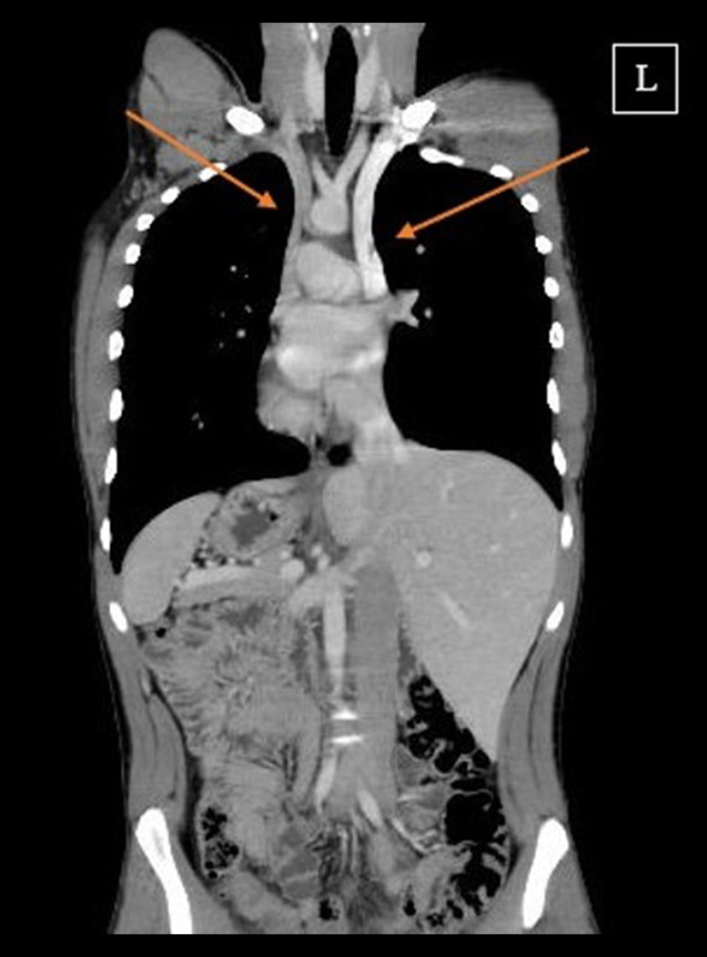 Coronal view of the chest and abdomen CT scan. The arrows point to the right and left superior vena caves. SIT can also be observed by the left-sided liver and the right-sided spleen and stomach.