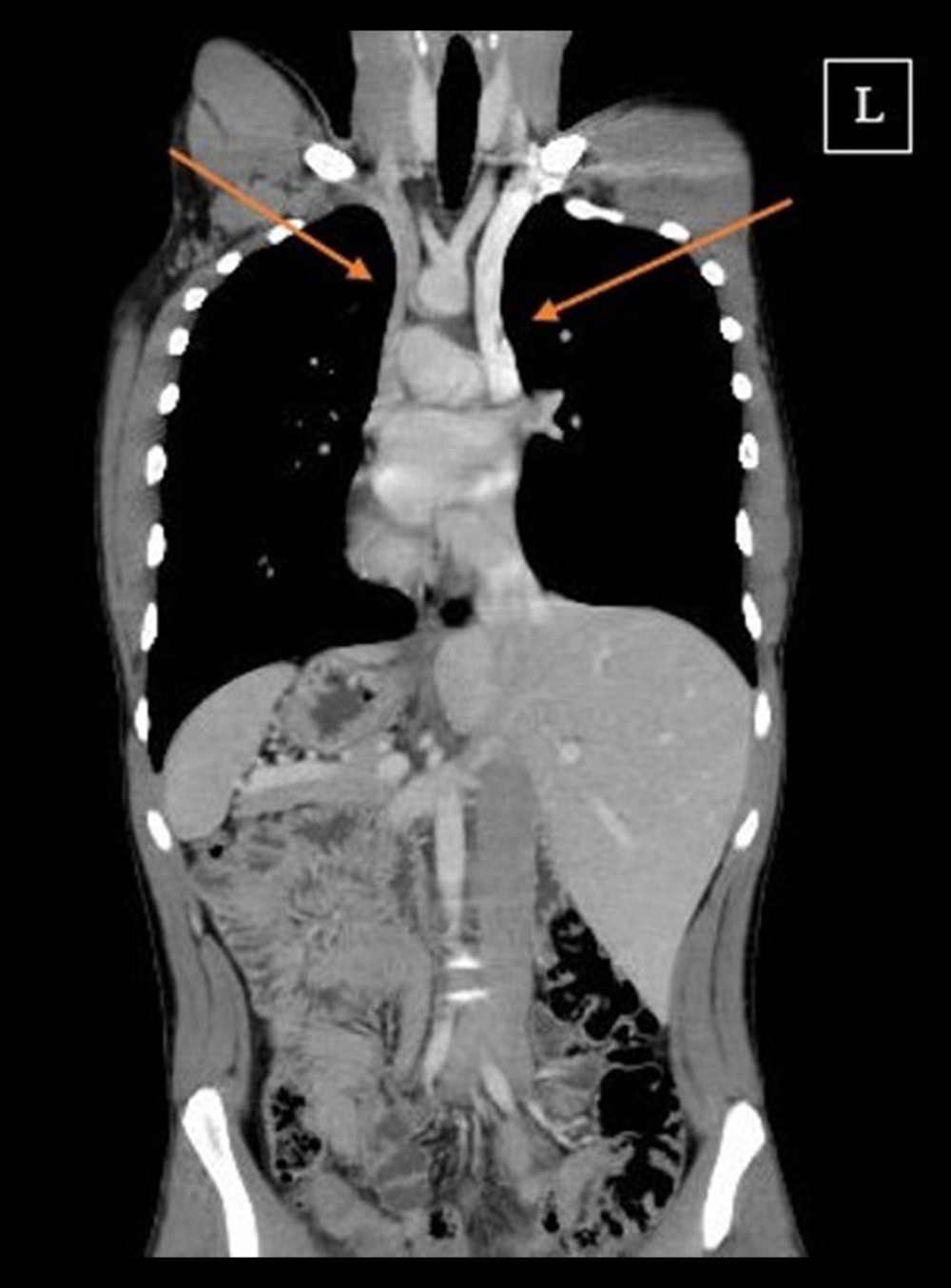 American Journal of Case Reports  Laparoscopic Cholecystectomy in