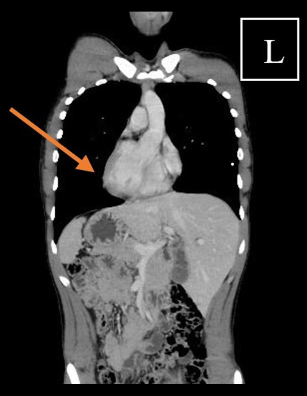 Axial chest CT scan showing dextrocardia. The arrow points to the left ventricle.