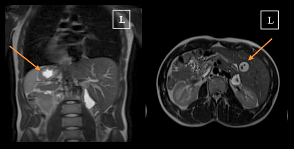 Axial and coronal views of MRCP image with dilated CBD and multiple stones by the appearance of filling defect of the gallbladder.