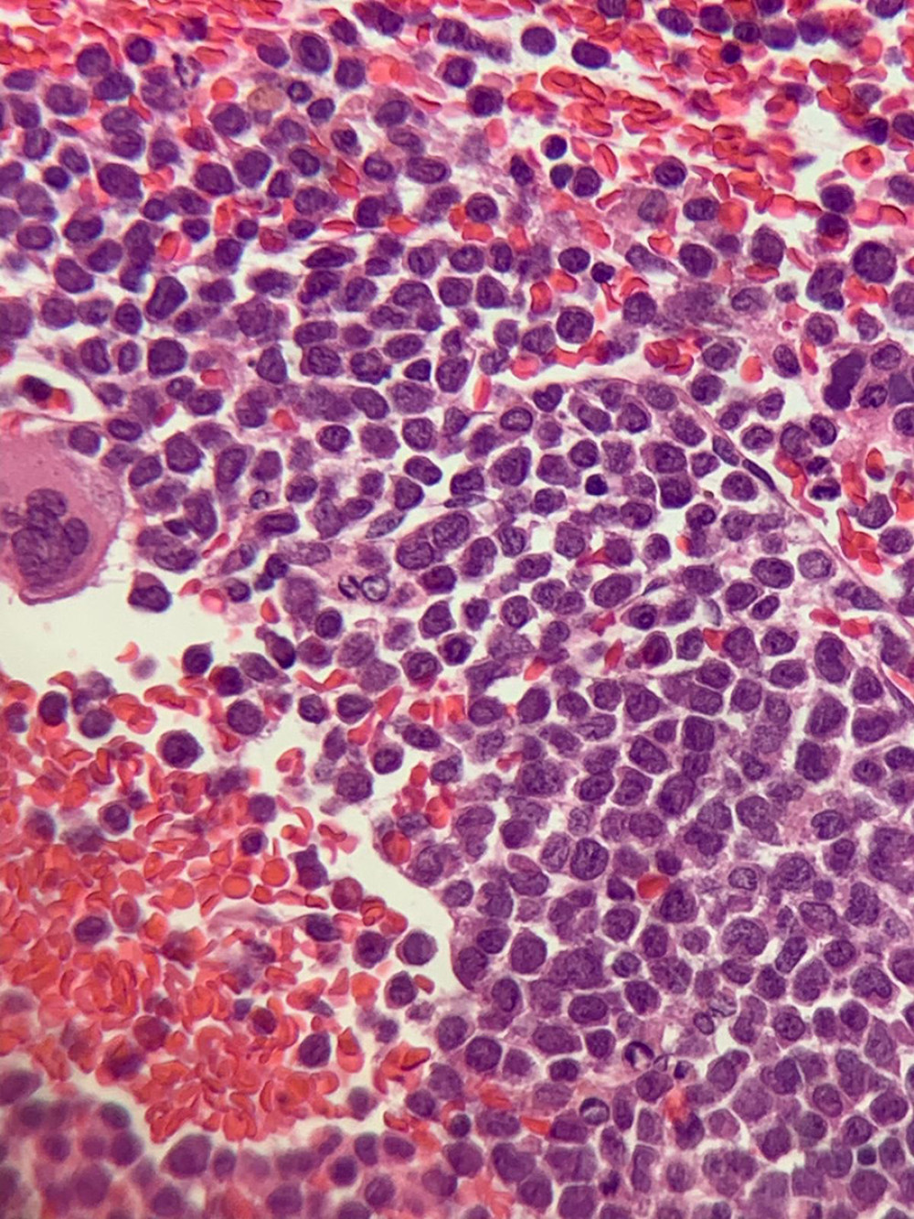 Bone marrow biopsy showing hypercellular bone marrow with a large number of monoblasts, and no auer rods seen.