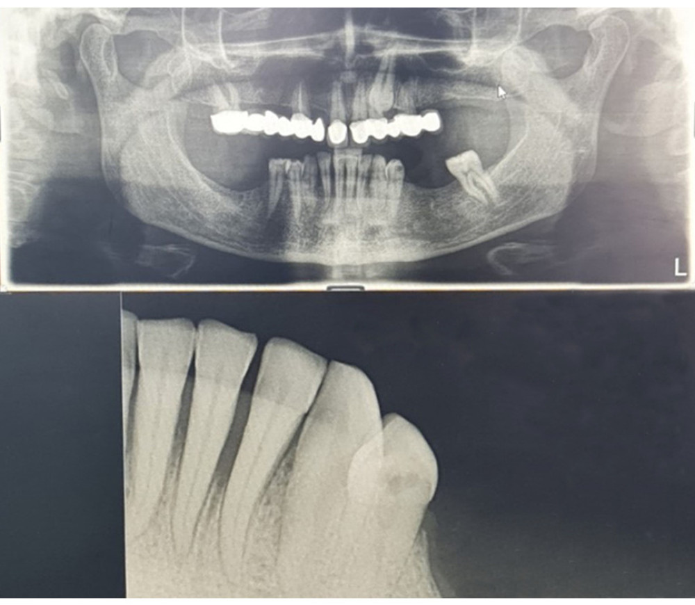 Radiographs show bone loss in the region of teeth 41-32.